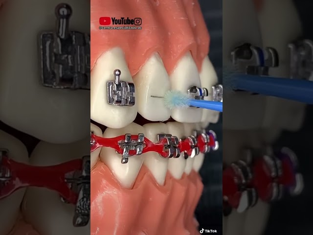 TUTORIAL: “Instalación de BRACKETS metálicos”