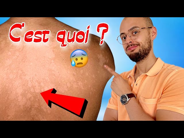 Comment soigner ce problème de peau ? 😰