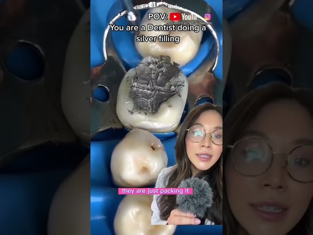 Dentist does a silver filling. #filling #cavity #silverfilling #dentist