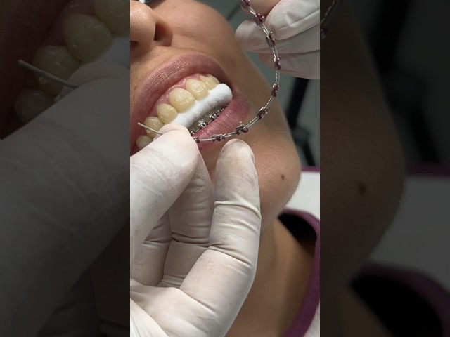 Having braces removed is something all patients look forward to. #brackets #orthodontics