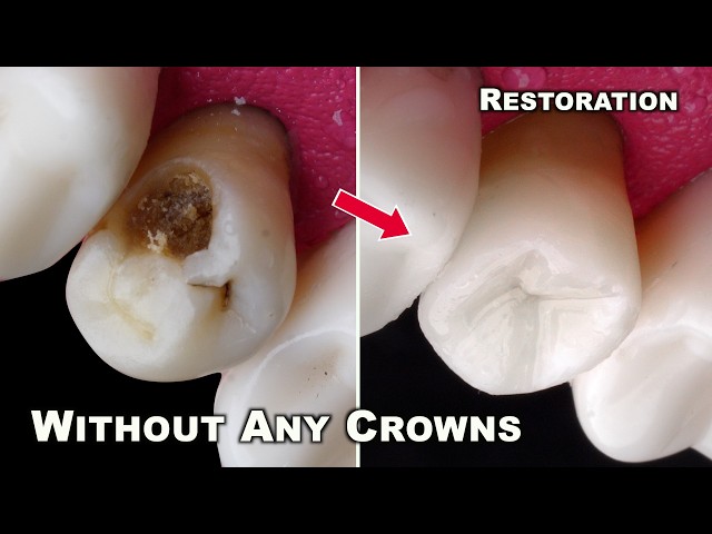 Awesome Tooth Restoration Without Dental Crowns ! Master Explanation