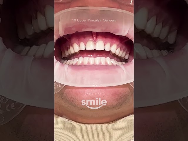Look at this stunning smile makeover with Porcelain Veneers 🤩  #dentist #smilemakeover
