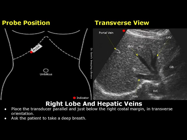 Posicionamiento de la sonda de ecografía hepática | Colocación del transductor para ecografía hep...