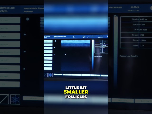 Ultrasound Secrets  Cat Mode & Zooming for Tiny Follicles!