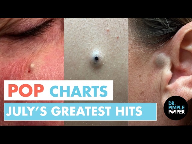 Dr. Pimple Popper’s Top 10 Most-Watched Moments of July