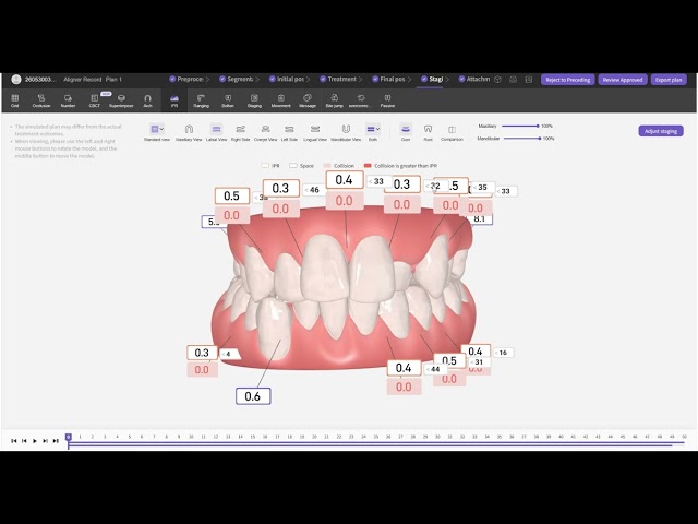 Complex Clear Aligner Case | Extraction + IPR + Molar Distalization + Implant Space Reservation