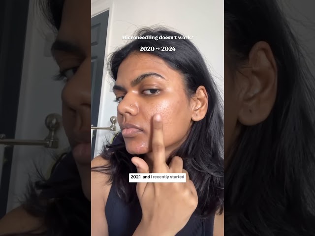 Building "new skin"  with microneedling takes time and patience #acne #acnescars #microneedling