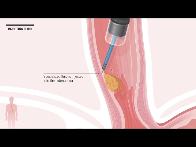 Endoscopic Submucosal Dissection
