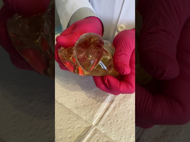 How Strong is a Breast Implant? Watch Dr. Doherty Cut Open a Breast Implant & Discuss the Results