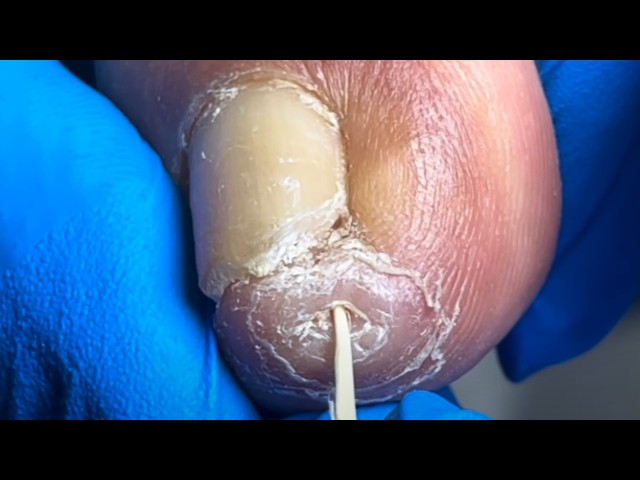 The Worst Toenail On Earth! “Thorn Inside The Toe【Pedicure Master Lin Jun】