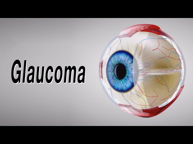 Glaucoma (Animation of Why It Happens and How It Can Cause Blindness)