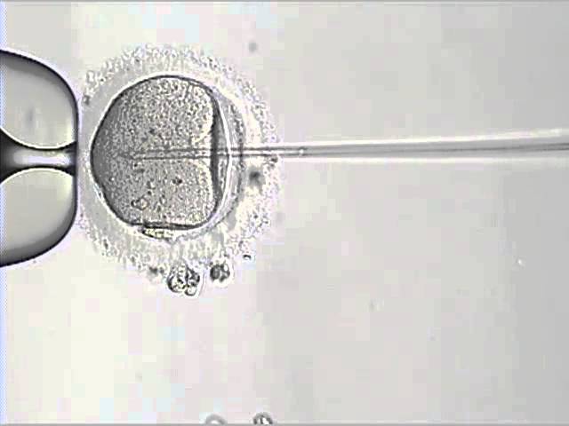 Intracytoplasmic Sperm Injection Procedure (ICSI)