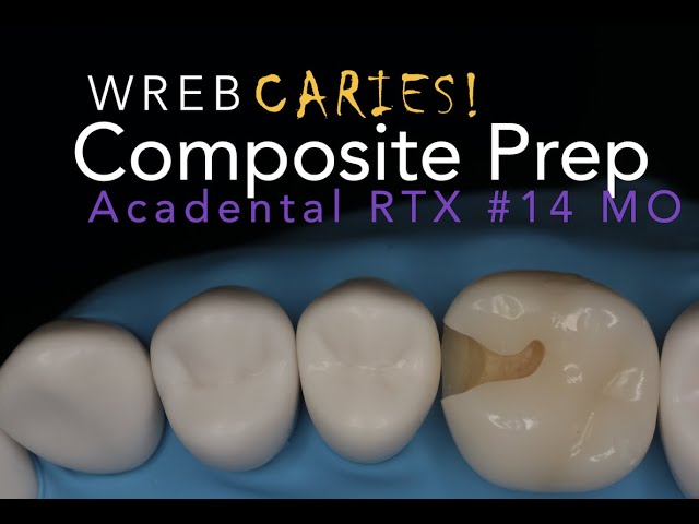 Class II #14 MO Preparation RTX Caries Tooth for WREB