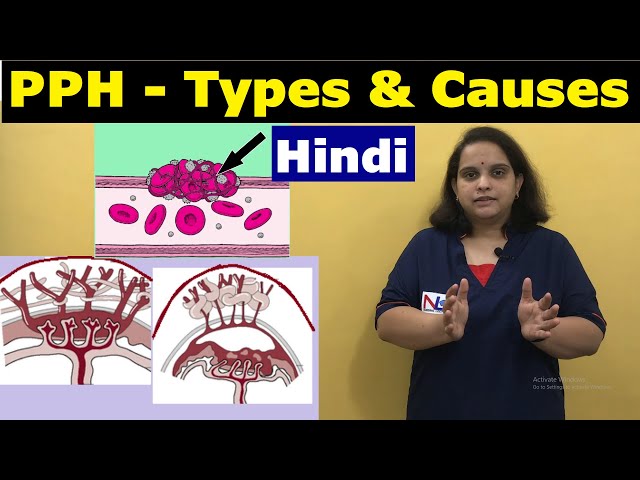 Postpartum hemorrhage in Hindi | Causes and Types of PPH | Nursing Lecture