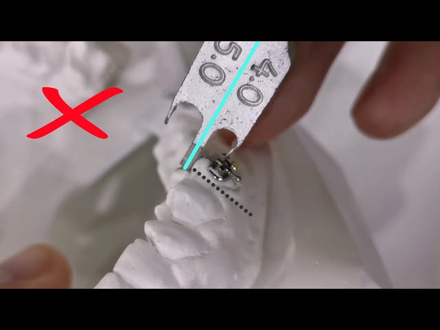 Bracket positioning, braces placement using height gauge