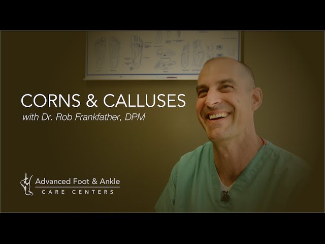 Corns & Calluses - Symptoms & How To Get Rid Of Them