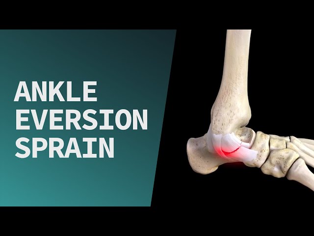 Ankle Eversion Sprain