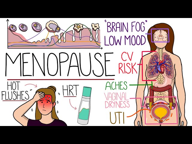 Menopause Explained Clearly (Includes HRT & Perimenopause)