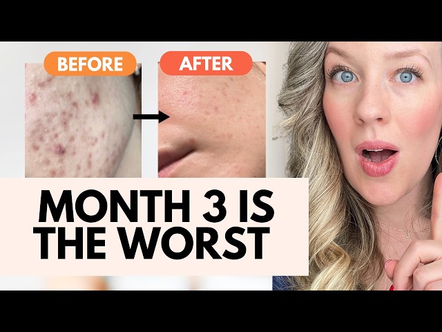 Acne After Stopping Birth Control: The 4-System Timeline Nobody Prepares You For
