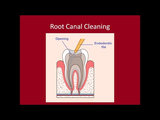 Root Canal Therapy