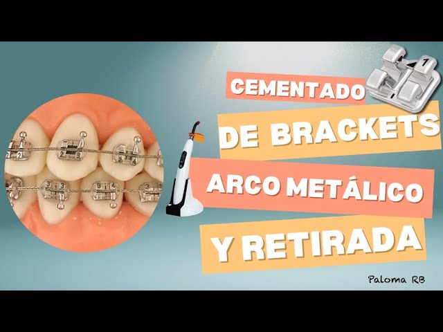 🎥 Cementado de brackets y colocación del arco + retirada de brackets 🔥