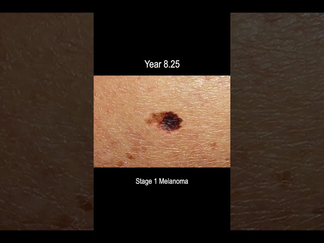 Melanoma Skin Cancer Development Time Lapse (Normal to Stage 4 Melanoma Over 10 Years)