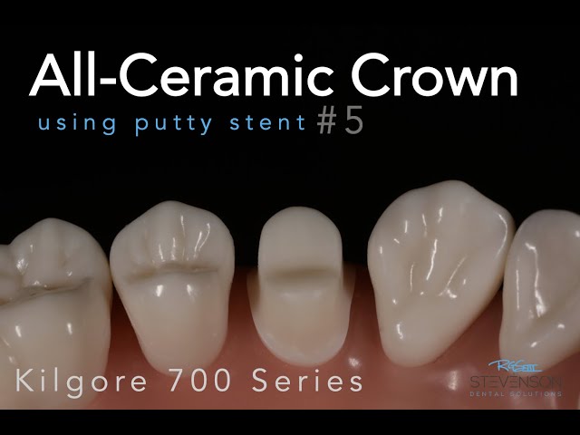 All Ceramic Prep #5 Kilgore 700 Series Typodont