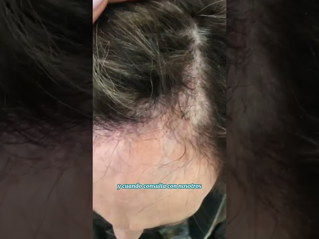 Tratamiento para Caída de Pelo  - Dr. Angélica Domínguez Dermatóloga en bogotá