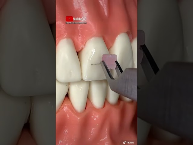 ¡Proceso completo para instalar BRACKETS ESTÉTICOS!