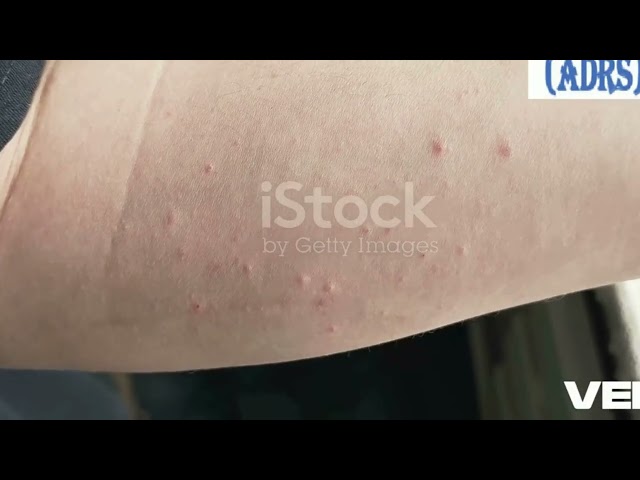 Pharmacovigilance & Clinical Trials: Adverse Drug Reaction (ADSR)