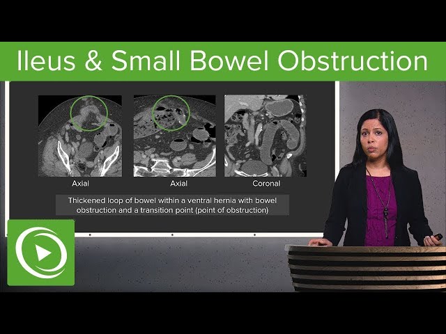 Obstrucción intestinal e íleo: obstrucción del íleo y del intestino delgado - Radiología | Lecturio