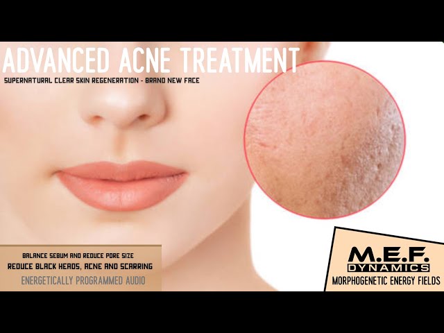 Acne Gone