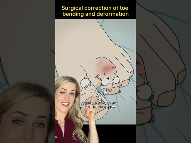 Doctor explains: hammertoe surgery
