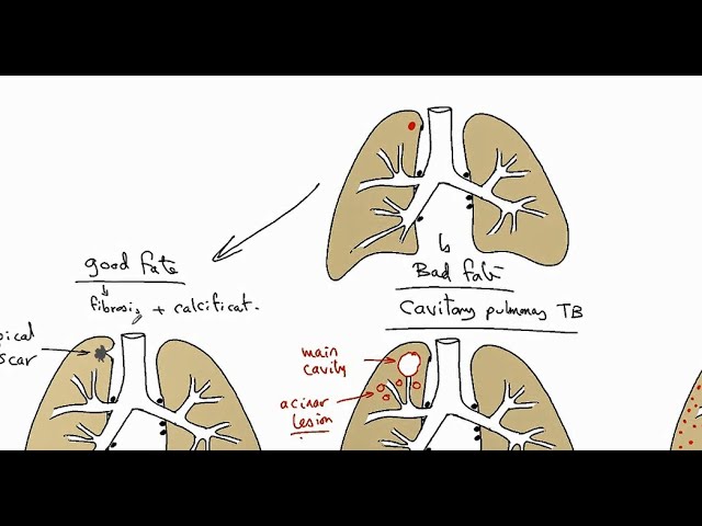 GENERAL PATHOLOGY 24: pulmonary tuberculosis DR SAMEH GHAZY
