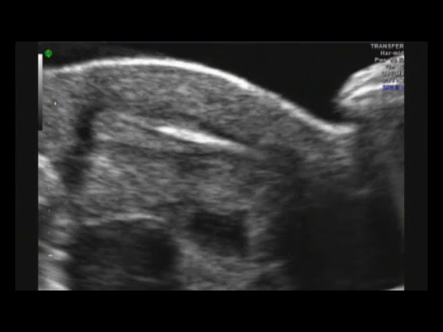Embryo Transfer During IVF