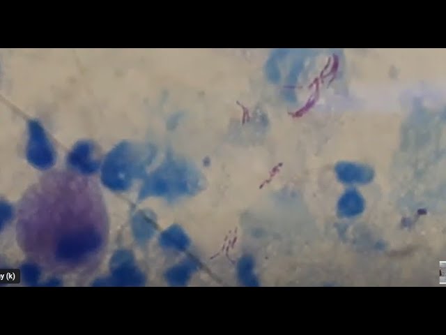 Numerous acid fast bacilli in Modified Z- N staining