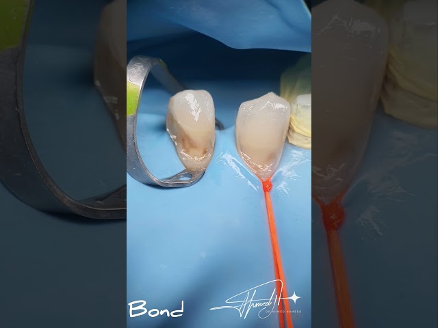 class 5 restorations