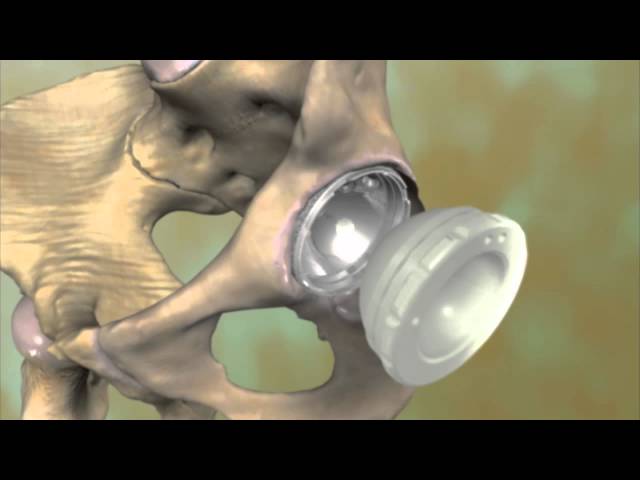 Total Hip Replacement