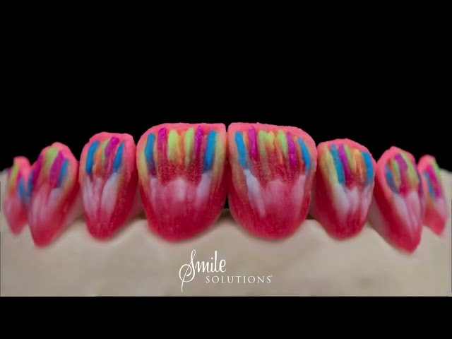 Porcelain Veneers multi-layering with Emax Press and Cream technique
