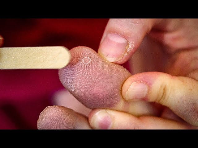 The Best Method for Removing Warts | Earth Science