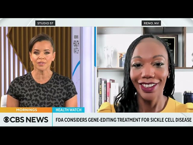 Dr. Curry-Winchell on CBS News: New Sickle Cell Treatment