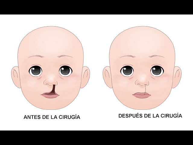 EL DOCTOR EN CASA TV - PROCEDIMIENTOS PARA FISURAS PALATINAS Y OREJAS EN PANTALLA