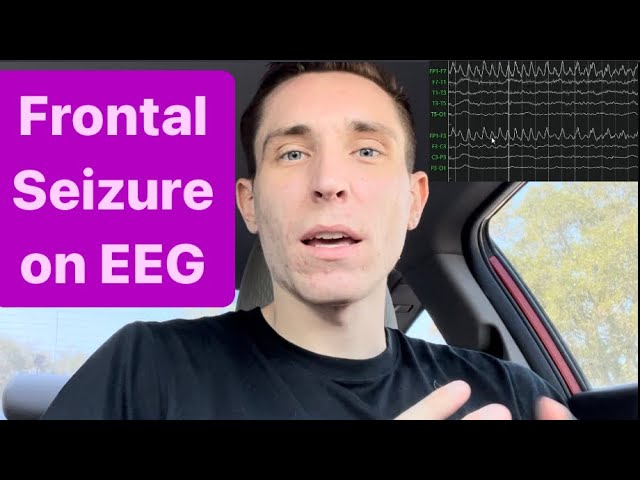 EEG With a Left Frontal Seizure