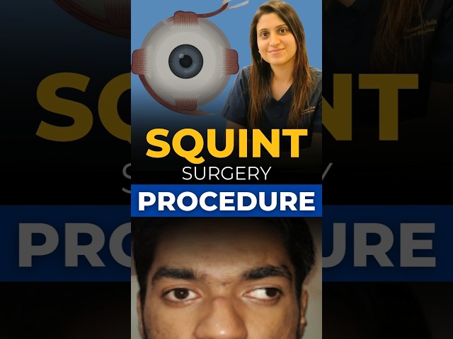 Squint Surgery Procedure: Step-by-Step Explained!