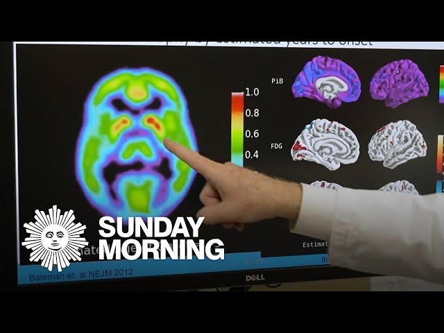 Promising clinical trials in Alzheimer's prevention