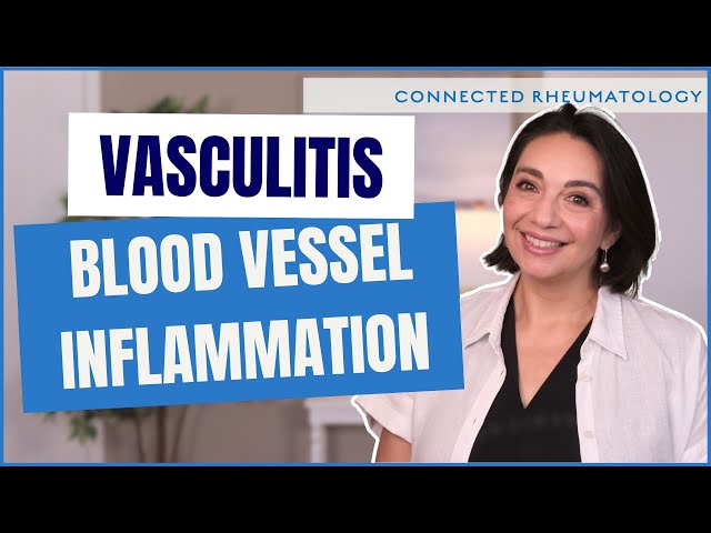 ¿Qué es la vasculitis? Infórmese sobre esta enfermedad autoinmune rara, pero mortal.