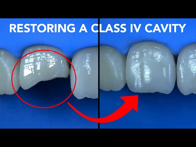 Class IV Restoration with G-aenial A'CHORD