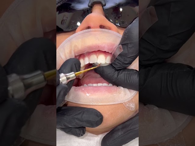Composite bonding by Dr. Matt 😍 #ruhdental #compositebonding