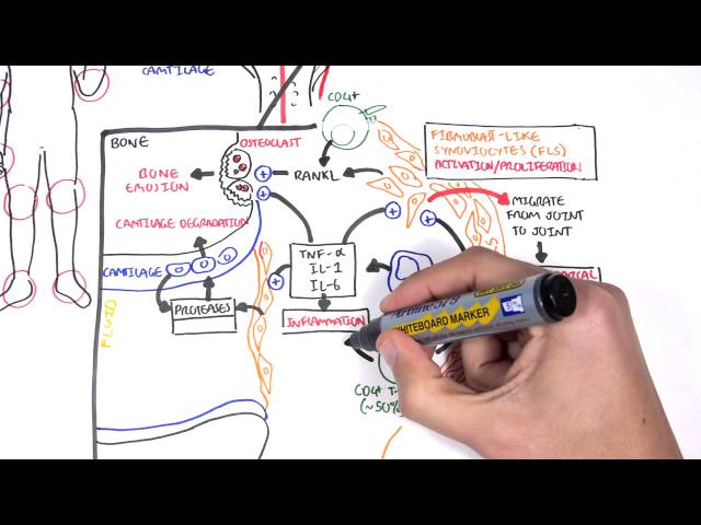 Rheumatoid Arthritis Pathophysiology (signs and symptoms)