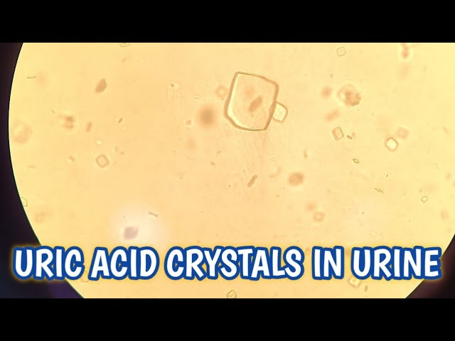 Uric acid crystals seen in urine microscopy.Urine infection#urineanalysis kidneyhealth#microscope 